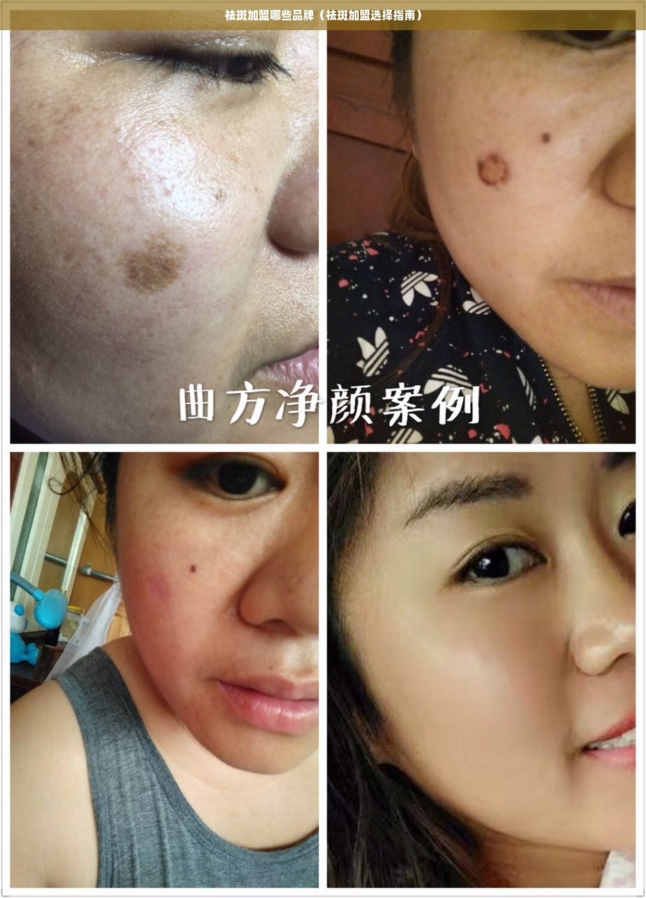 祛斑加盟哪些品牌（祛斑加盟选择指南）