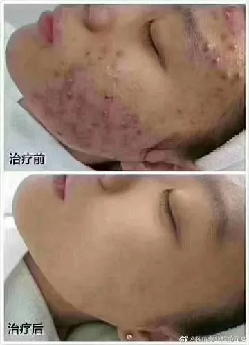 漯河祛粉刺代理怎么加盟 漯河治痘痘哪个医院比较好