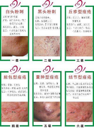 漯河祛粉刺代理怎么加盟 漯河治痘痘哪个医院比较好