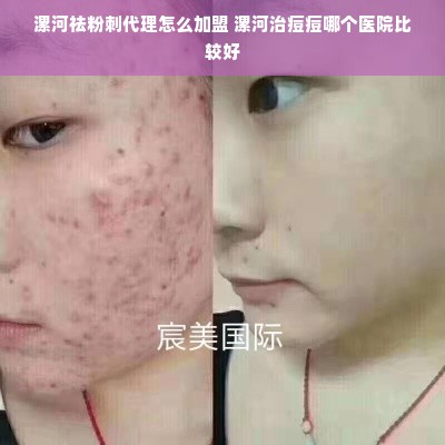 漯河祛粉刺代理怎么加盟 漯河治痘痘哪个医院比较好