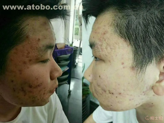 焦作祛痘印加盟怎么代理 焦作市哪家医院看痘痘比较好